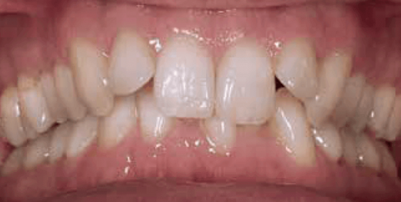 invisalign_vorher.PNG