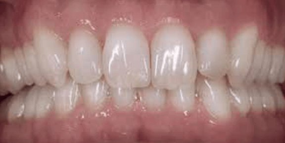 invisalign_nachher.PNG